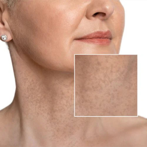 Uneven Skin Tone
