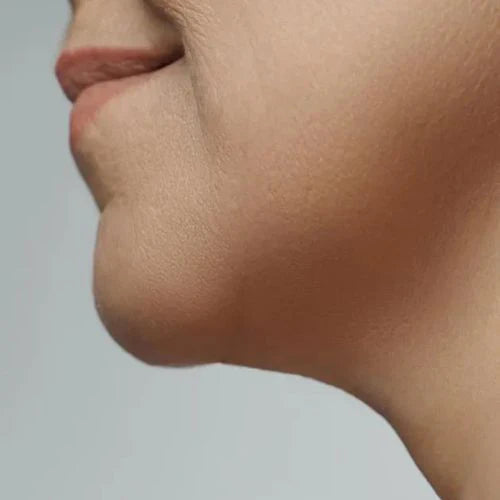 Loss of Jawline Definition