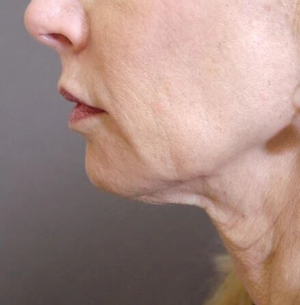 Turkey Neck Sagging Skin